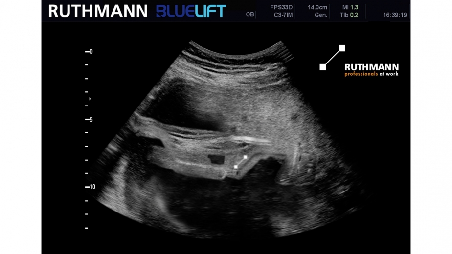 Ultraschall-Video Newborn RUTHMANN BLUELIFT Raupenarbeitsbühne zur APEX 2020