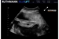 Ultraschall-Video Newborn RUTHMANN BLUELIFT Raupenarbeitsbühne zur APEX 2020